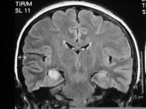 REFRACTORY-EPILEPTICUS-STATUS-AND-BILATERAL-MESIAL-TEMPORAL-INVOLVEMENT ...
